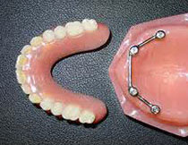 Dental implants