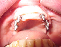 Dental implants