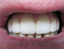 Dental implants