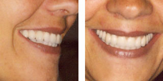 Dental implants