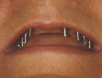 Dental implants