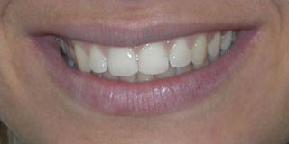 Blanqueamiento dental