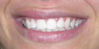 Blanqueamiento dental