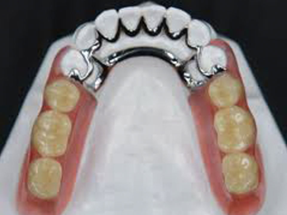 Gemas Dentales #dentist #protesis 