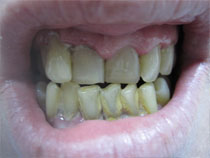 Periodoncia