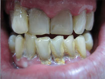 Periodoncia